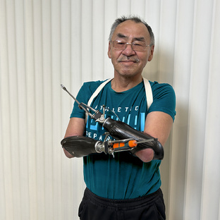 Протезирование верхних конечностей