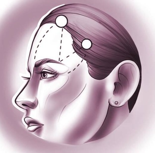 Эндоскопическая подтяжка лба