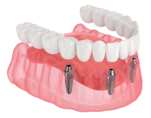 Все-на-4х (all-on-4)