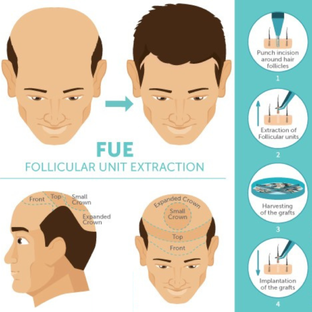 Пересадка волос методом FUI