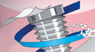 Биоматериалы Geistlich для НКР