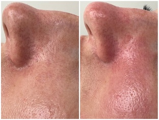 Чистка лица