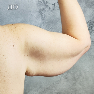 Брахиопластика