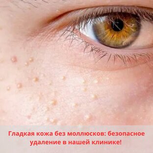 Удаление новообразований