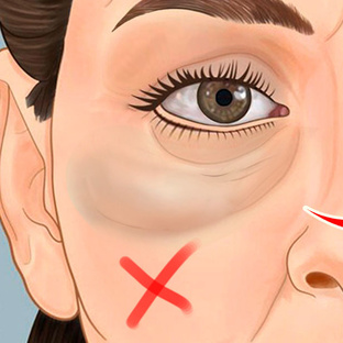 От отеков лица и мешков под глазами