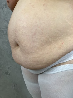 Абдоминопластика