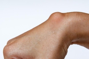 ЛЕЧЕНИЕ ГИГРОМЫ В НАРОДНОЙ МЕДИЦИНЕ