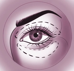 Круговая блефаропластика 