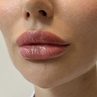 ПЛАСТИКА ГУБ (ХЕЙЛОПЛАСТИКА)