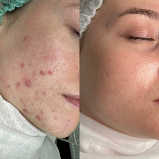 Результаты лечения акне