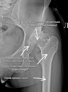 Дисплазия тазобедренного сустава