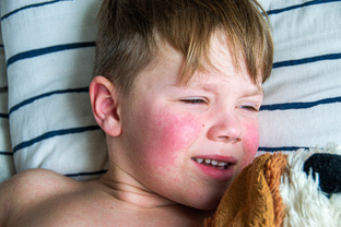 Атопический дерматит
