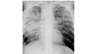 Диагностика туберкулеза