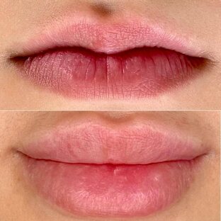 Контурная пластика