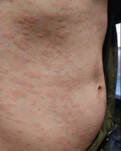 ДЕРМАТОЛОГИЯ