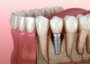 Имплант зуба (корень зуба - имплант)