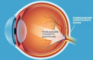 Глаукома
