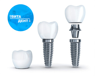 Имплантация