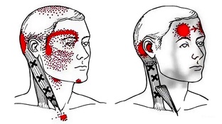 Боль в мышцах. Триггерные точки