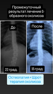 Лечение сколиоза 