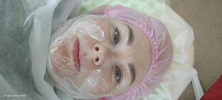 Липолитик в лицо и пилинг Джесснера 