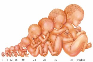 Преждевременные роды. Экстремально ранние. 