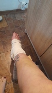 Жизнь после перелома лодыжки