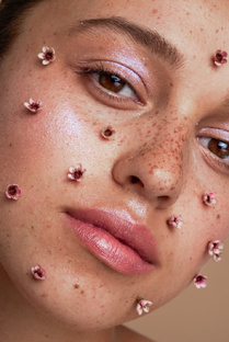 АКНЕ (лечение без приема системных ретиноидов)