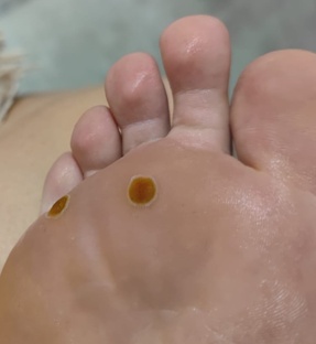 Подошвенная бородавка