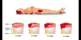 Пролежни