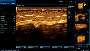 УЗИ молочных желез