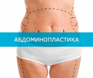 Абдоминопластика