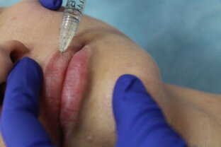 Их называют"Уколы красоты". Подробнее о филлерах и контурной пластике