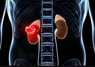 Онкология.Урология