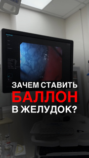 Баллон для похудения