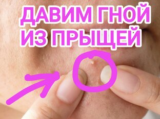 сочные гнойные прыщи