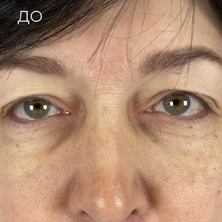 Блефаропластика