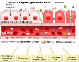 Синдром проницаемости кишечника