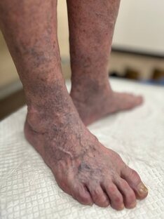 гемангиома