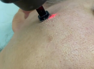 Лазерная шлифовка