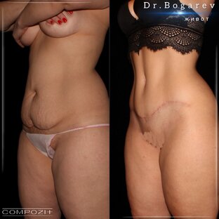 Пластика живота