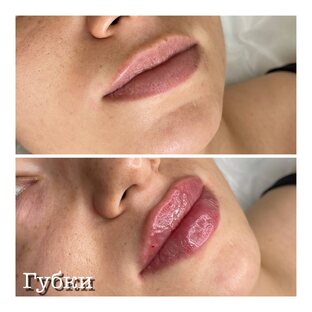 Контурная пластика губ