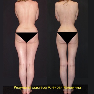 РУЧНАЯ ПЛАСТИКА, ЛИПОСАКЦИЯ, ЛИПОПЛАСТИКА ТЕЛА. КОРРЕКЦИЯ ФИГУРЫ. ДО И ПОСЛЕ. 