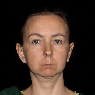 Омоложение лица | А. С. Богарев