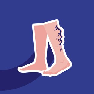 Заболевания вен