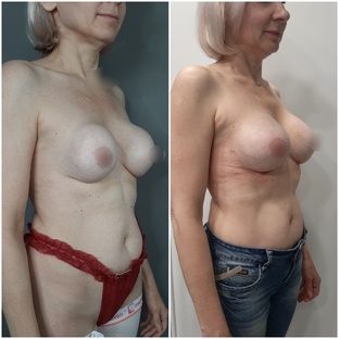 Маммопластика -пластика груди