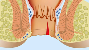 Анальные трещины