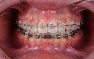 Брекеты и элайнеры