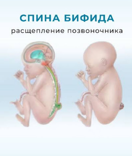 Спина бифида 
