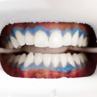 Отбеливание